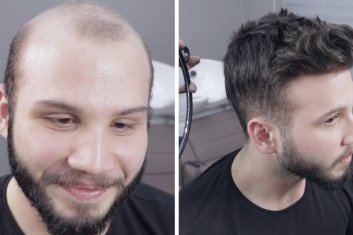 Saç Protezi Nasıl Takılır?